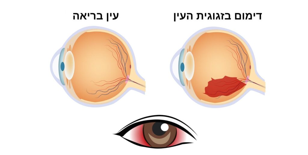 עין בריאה ועין עם דימום בזגוגית העין