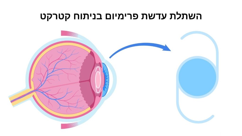השתלת עדשת פרימיום בניתוח קטרקט - דוקטור אפרים ברקו