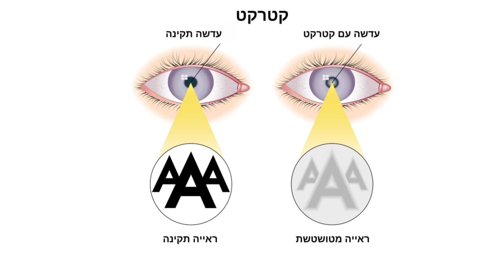 כיצד רואים אנשים שיש להם קטרקט בעין