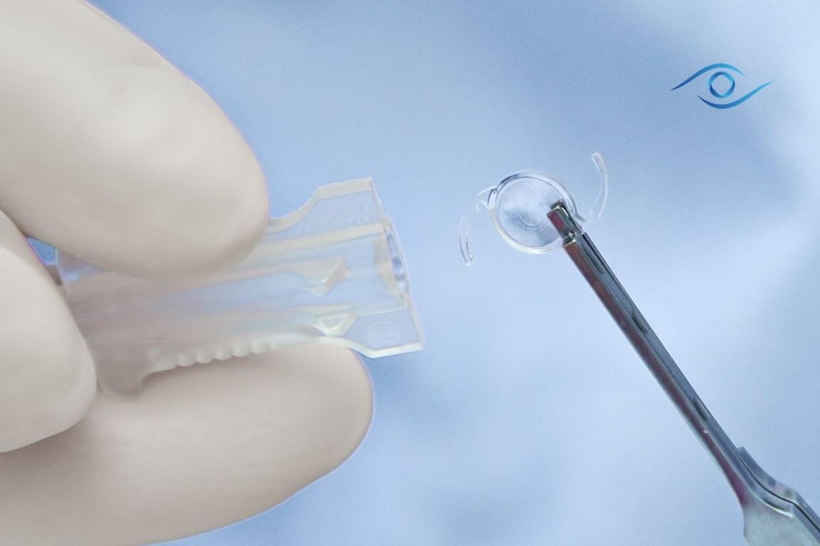 עדשה טורית בניתוח קטרקט - דר אפרים ברקו