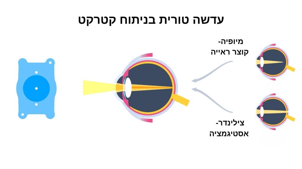 עדשת פרימיום טורית בניתוח קטרקט - דוקטור אפרים ברקו