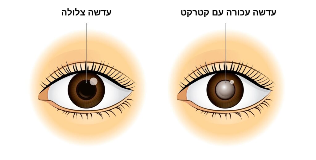 תמונה של עין בריאה ועין עם קטרקט